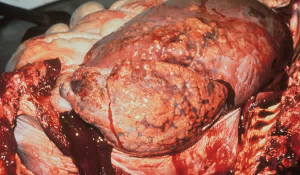 gastric carcinoma