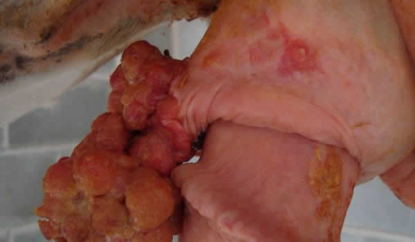 squamous cell carcinoma  penile